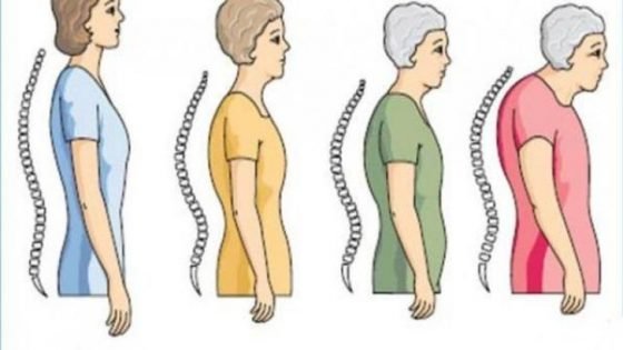 Osteoporoz Nedir Belirtileri Nelerdir ve Tedavi Yöntemleri Aysha